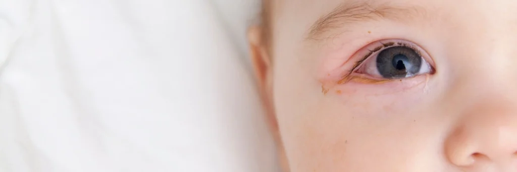 Wirusowe zapalenie oka u dziecka