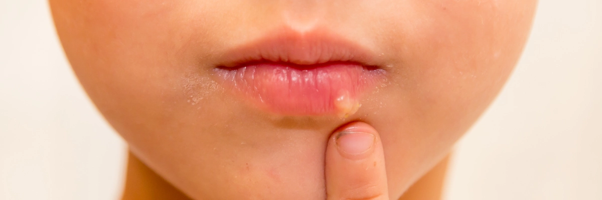 Opryszczka na ustach u dziecka