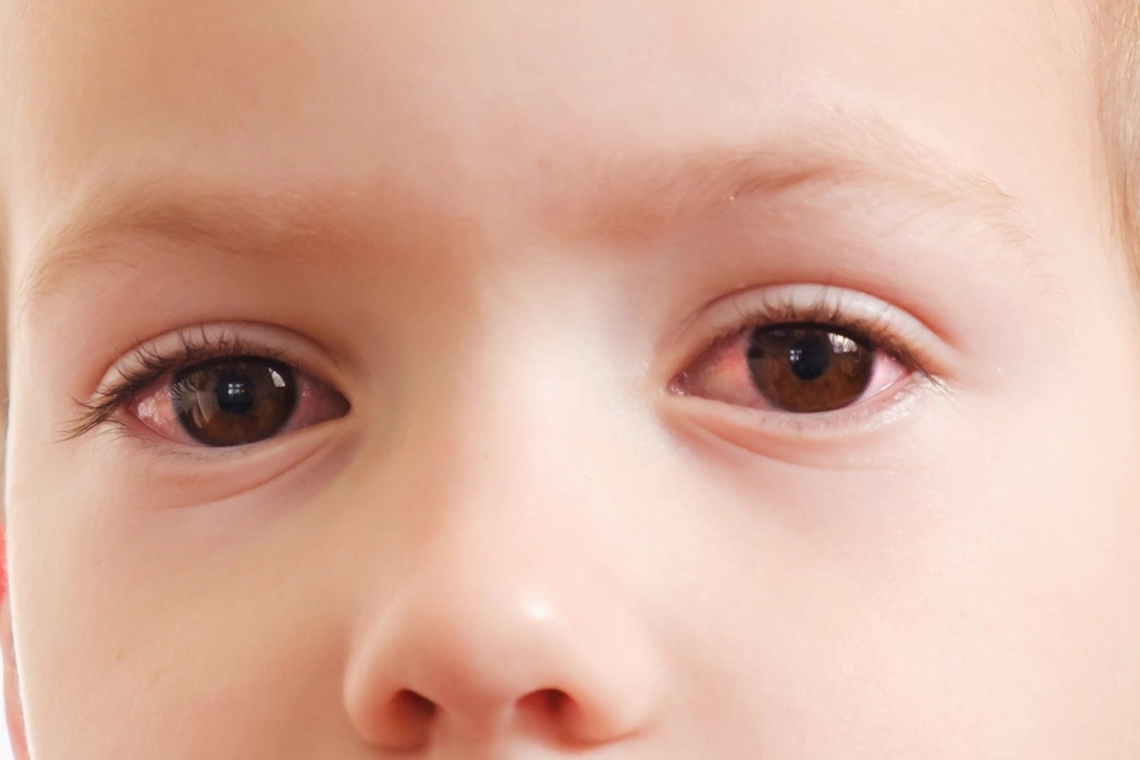 wirusowe zapalenia oka u dziecka